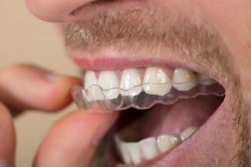 A clear acrylic dental stent being worn over the upper teeth